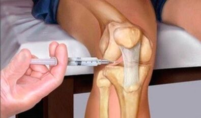 Hyaluronic acid with knee joint arthrosis