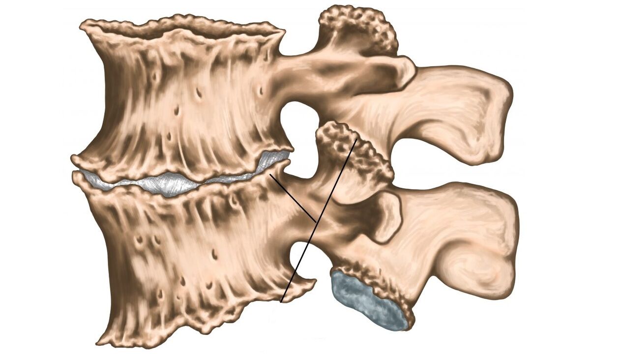 Spinal lesions caused by osteochondrosis