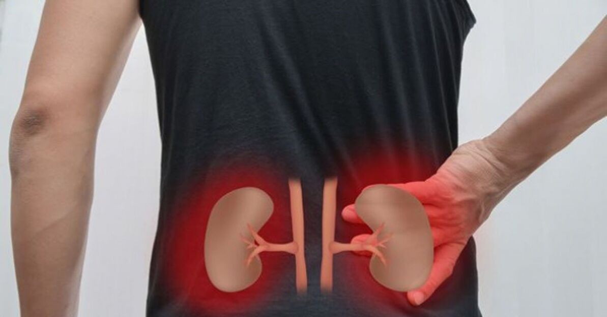 Kidney inflammation can cause lower back pain