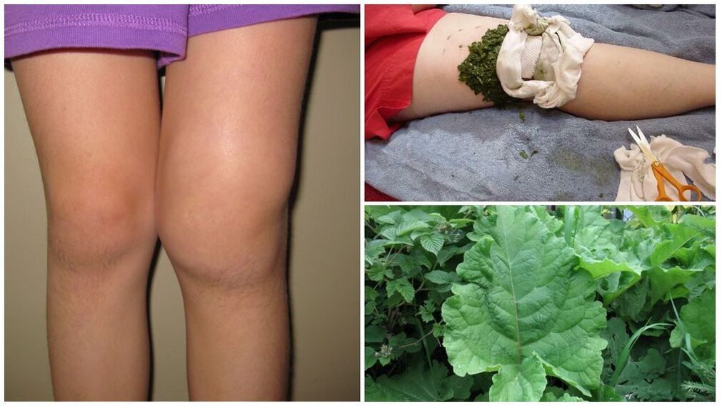 Compress on the knee with burdock - a folk method for treating gonarthrosis