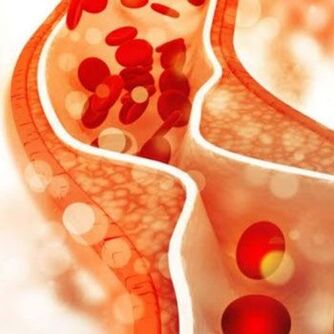 Cholesterol deposits on the inner walls of blood vessels cause pain in the neck